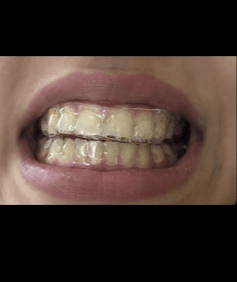 Aligners Case