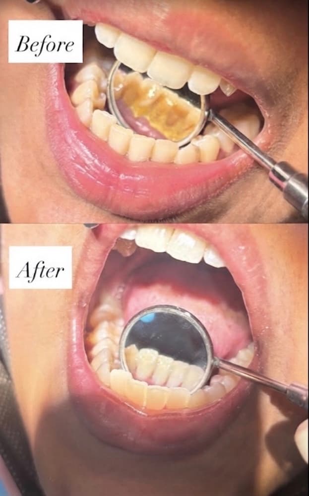 Before After Result 1