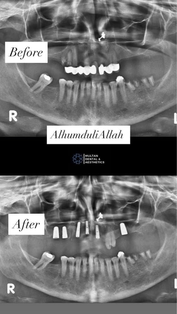 Implants Case