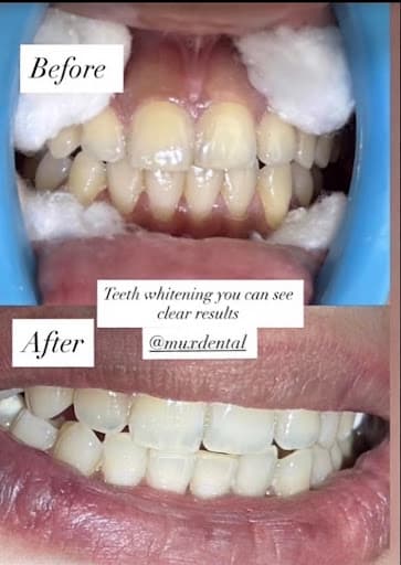 Teeth Whitening Results